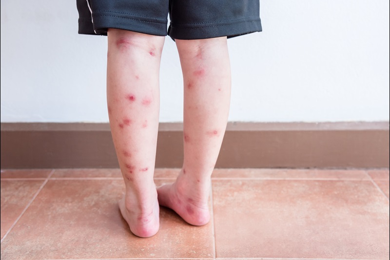 bed-bug-bites